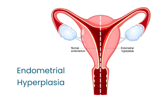 Endometrial Hyperplasia What Women Should Know About This Condition