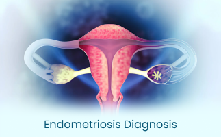 Endometriosis Diagnosis Symptoms Tests and Laparoscopy