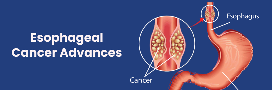 Esophageal Cancer Advances