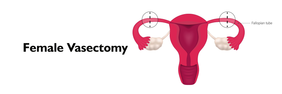 Female Vasectomy