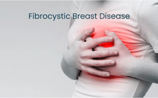 Fibrocystic Breast Disease Symptoms and Signs