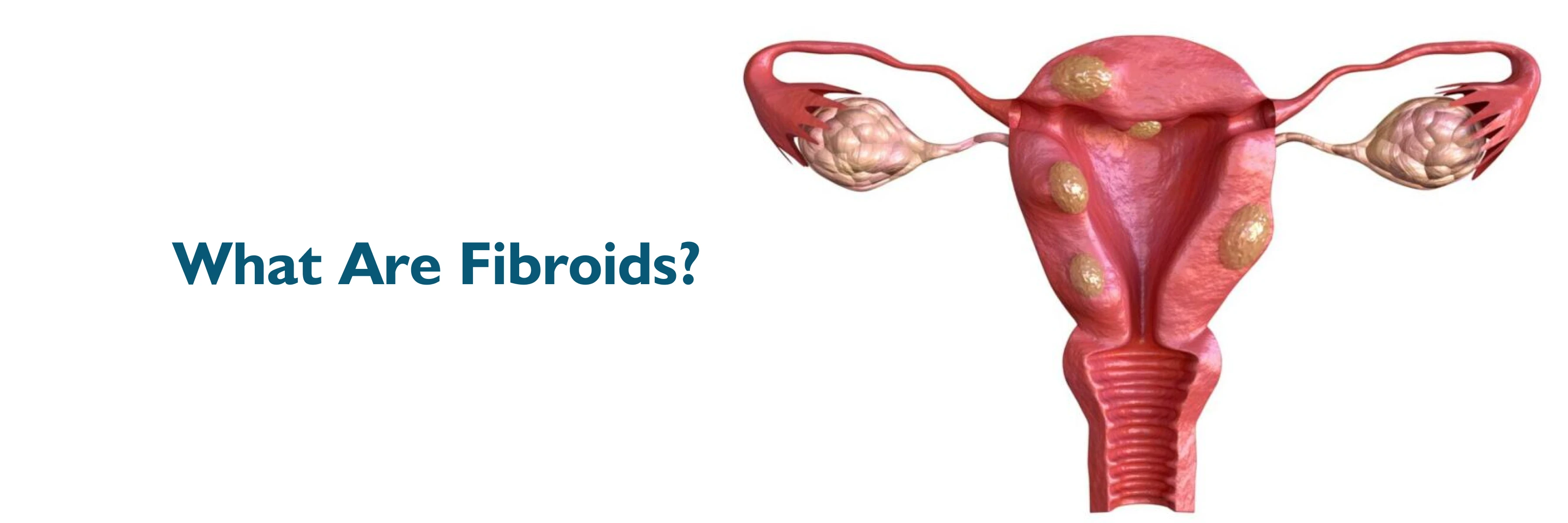 Fibroids