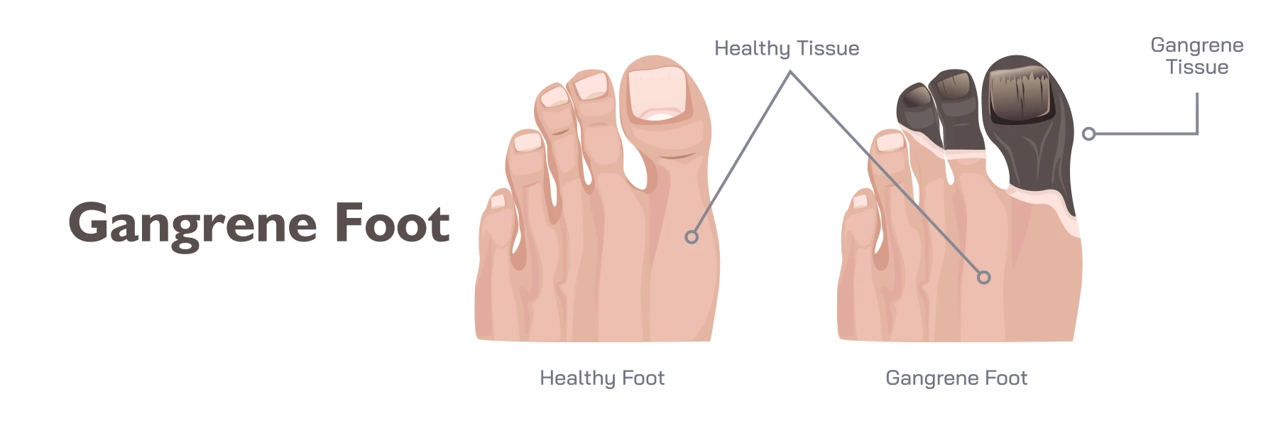 Gangrene Foot