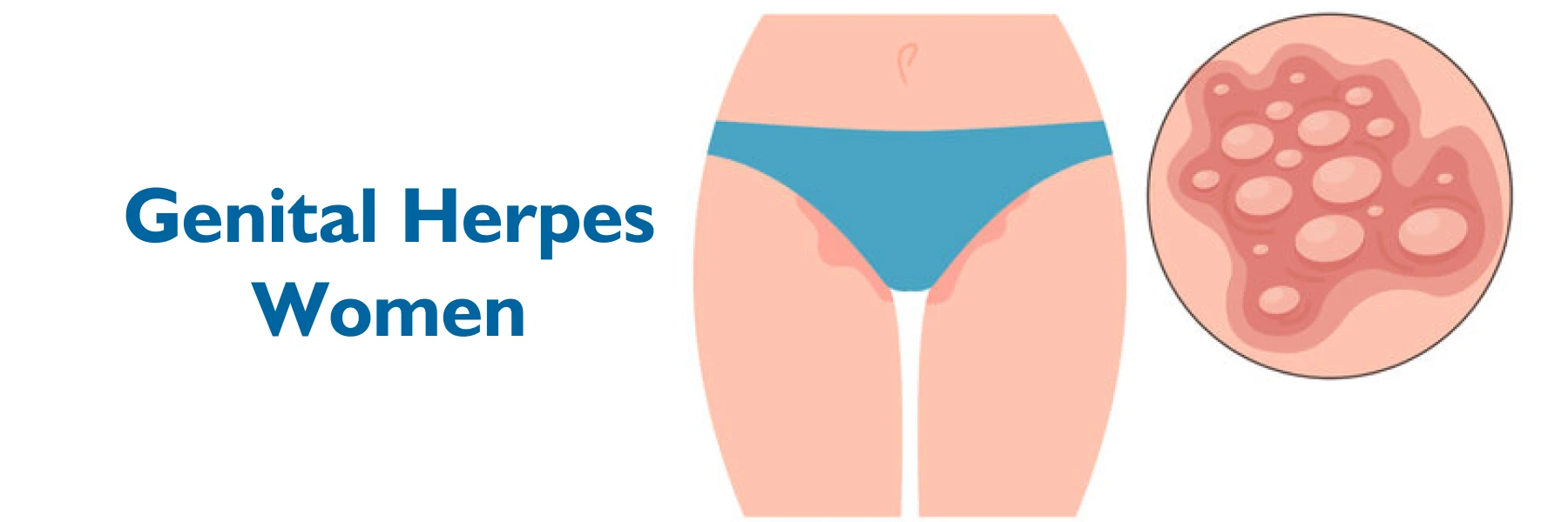 Herpes genital em mulheres sintomas, tratamento e complicações