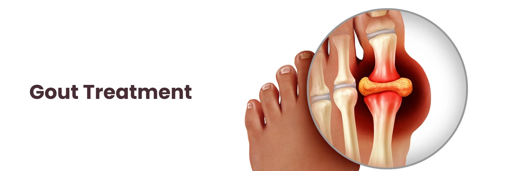 Gout-Treatment