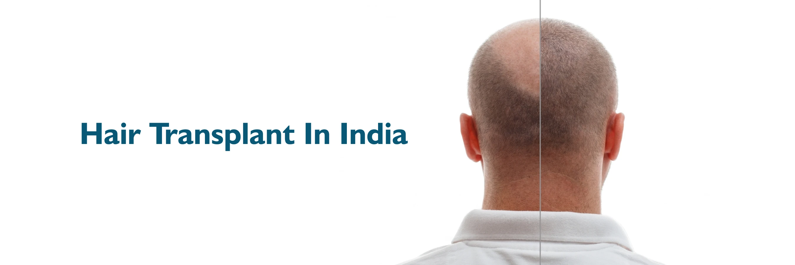 Hair Transplant Price in India