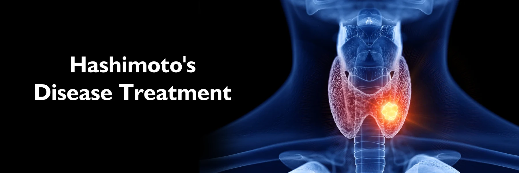 Hashimotos Disease Treatment