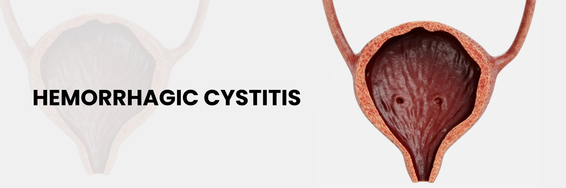 Hemorrhagic Cystitis