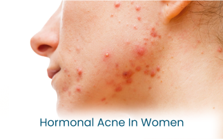 Best Treatments for Hormonal Acne in Women Causes  Signs