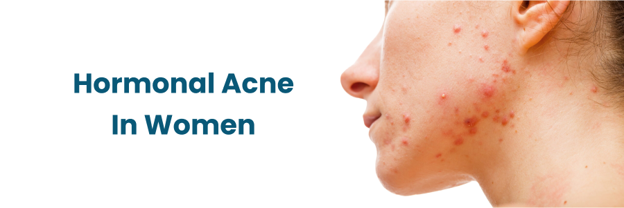 Hormonal Acne In Women