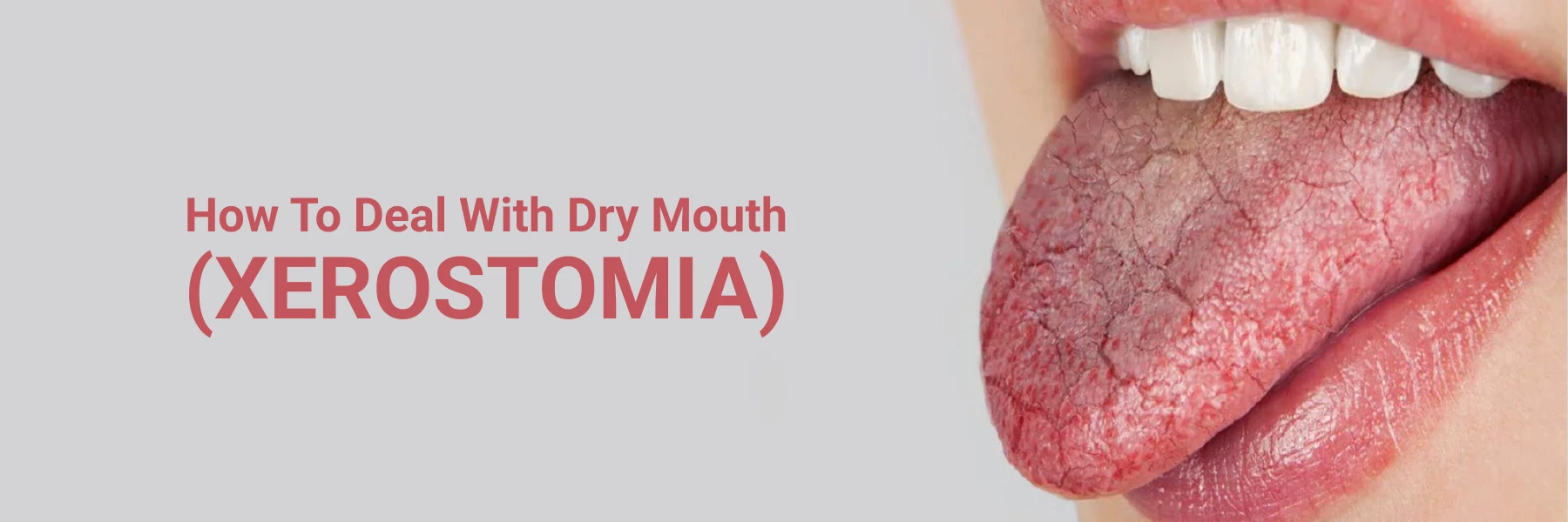 How To Deal With Dry Mouth