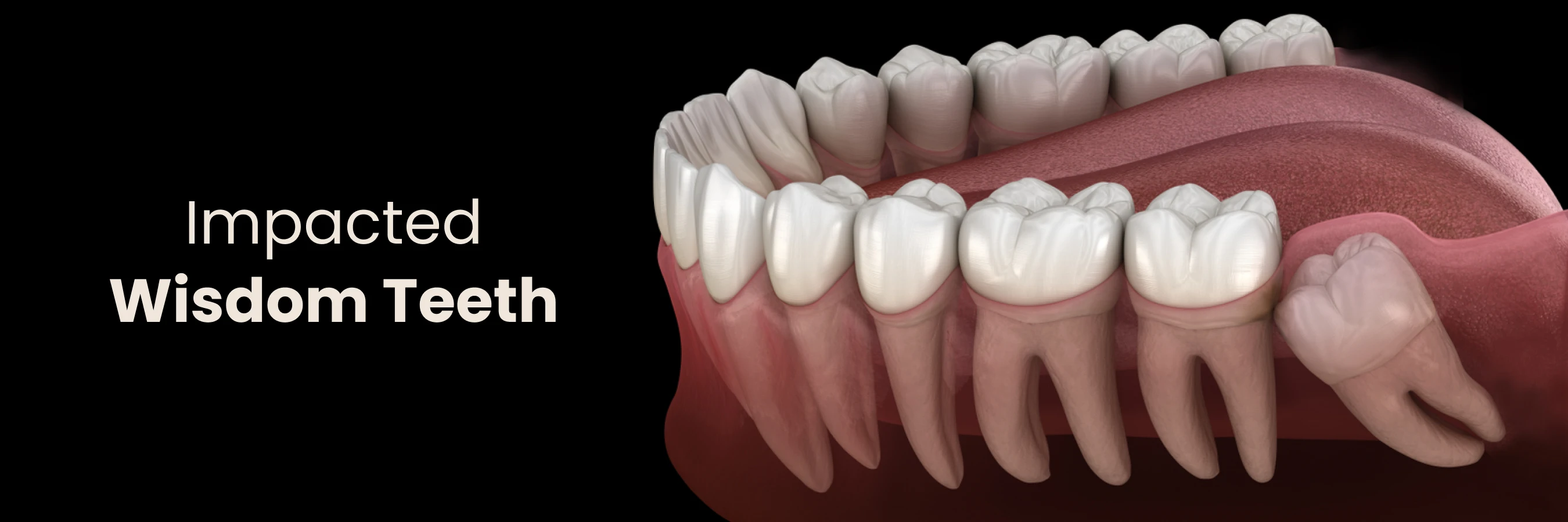 Impacted Wisdom Teeth