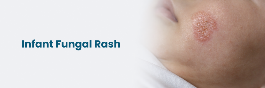 Infant Fungal Rash