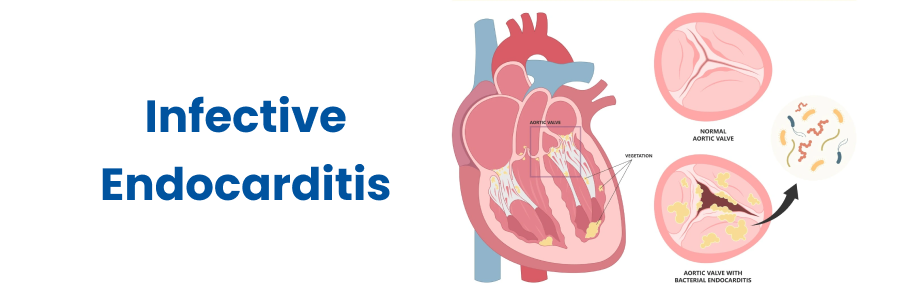 Infective Endocarditis