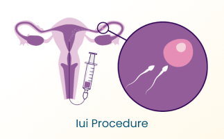 IUI Procedure Steps Tips and Conception