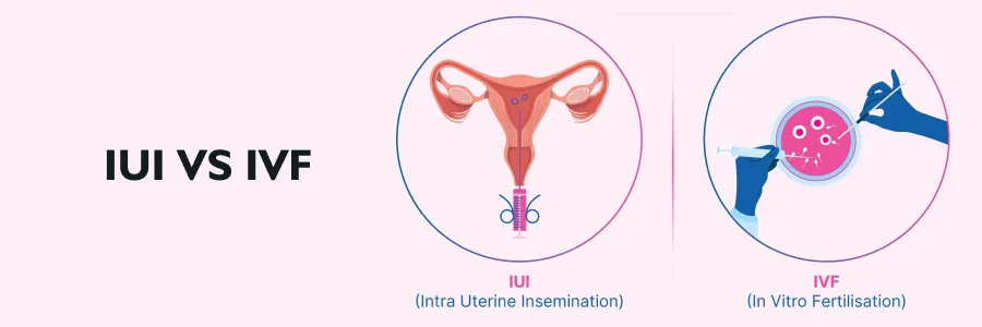 Fertility Issues and Treatment Differences Between IUI vs IVF