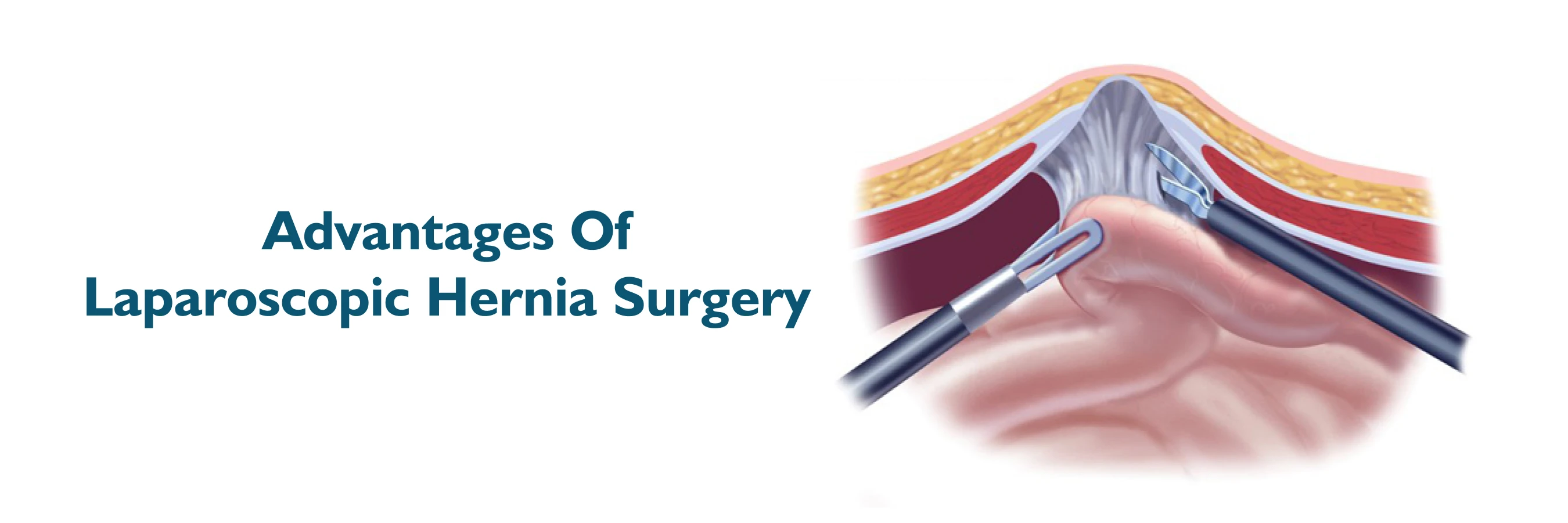 Benefits of Laparoscopic Hernia Surgery