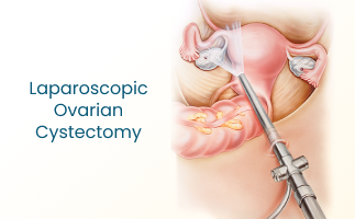 Laparoscopic Ovarian Cystectomy Procedure Guide