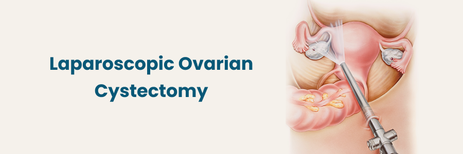 Laparoscopic Ovarian Cystectomy