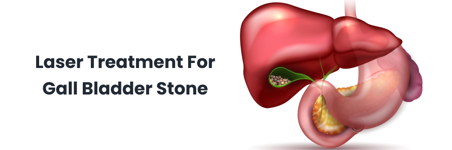 laser treatment for gall bladder stone