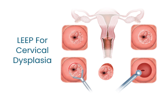 LEEP for Cervical Dysplasia Treatment  Medicover Hospitals