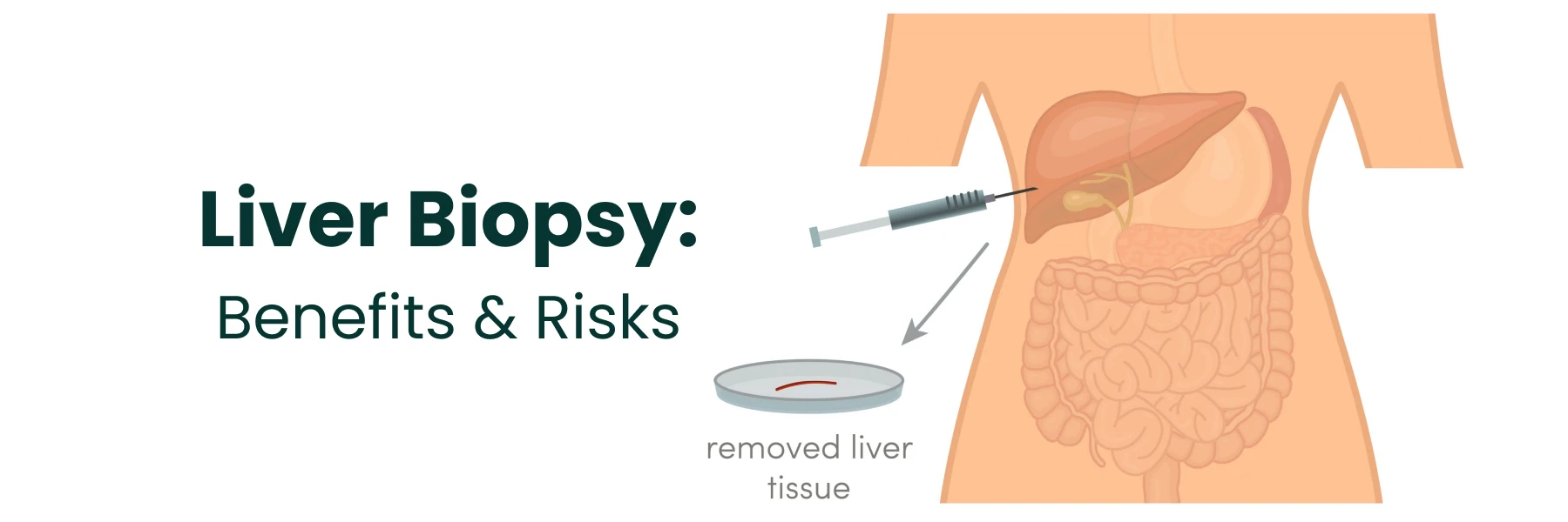 Liverbiopsy Risks Benefits