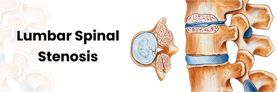 Lumbar Spinal Stenosis: መንስኤዎች, ምልክቶች, ምርመራዎች