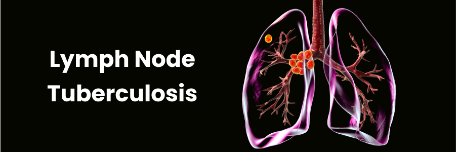 Lymph Node Tuberculosis