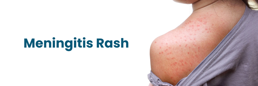 Meningitis Rash