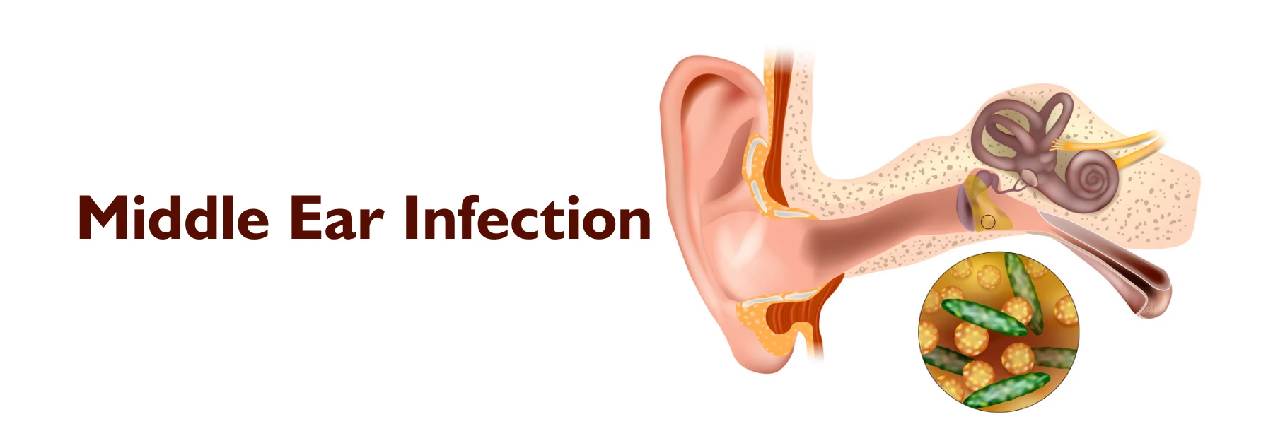 Middle Ear Infection