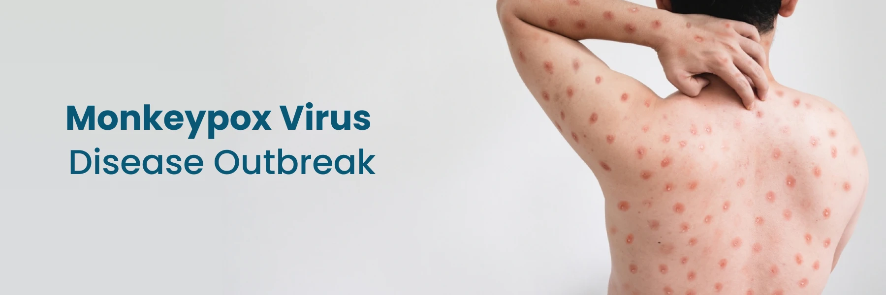 Monkeypox Virus Disease Outbreak