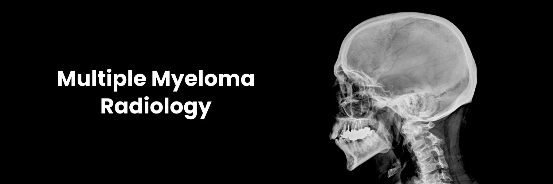 Multiple Myeloma Radiology