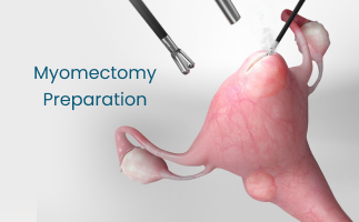 Myomectomy Surgery Preparation Steps for Fibroid Removal