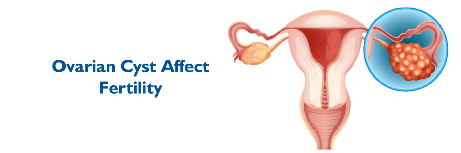 Ovarian Cyst Effect on Fertility, Ovarian Cysts and Fertility