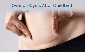 Managing the Symptoms of Ovarian Cysts After Childbirth