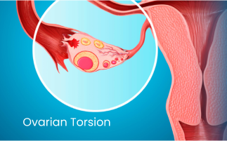 Ovarian Torsion Symptoms and Treatment