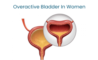 Managing Symptoms of Overactive Bladder in Women