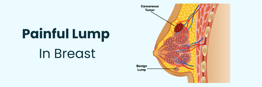 understanding-painful-lumps-in-breasts