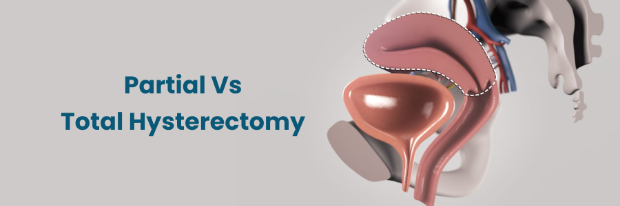 Partial vs. Total Hysterectomy