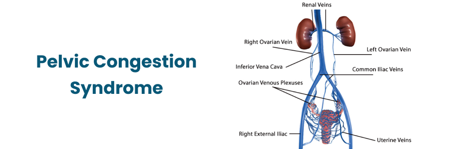 Pelvic Congestion Syndrome