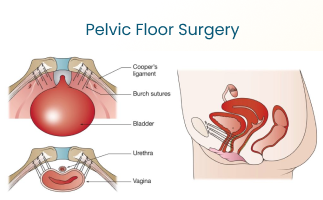 Pelvic Floor Surgery Treatment and Recovery