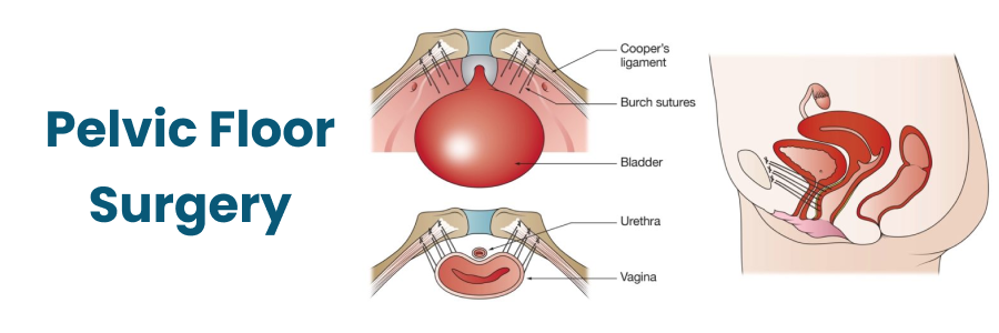 Pelvic Floor Surgery