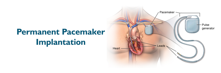 Permanent Pacemaker Implantation