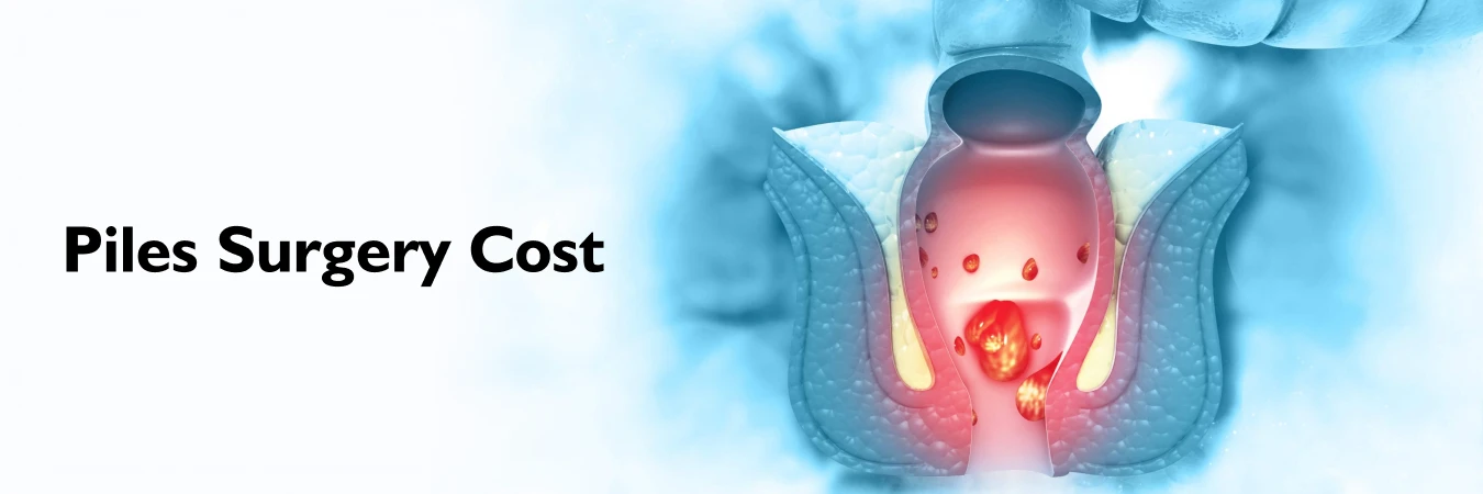 Cost of Piles Surgery
