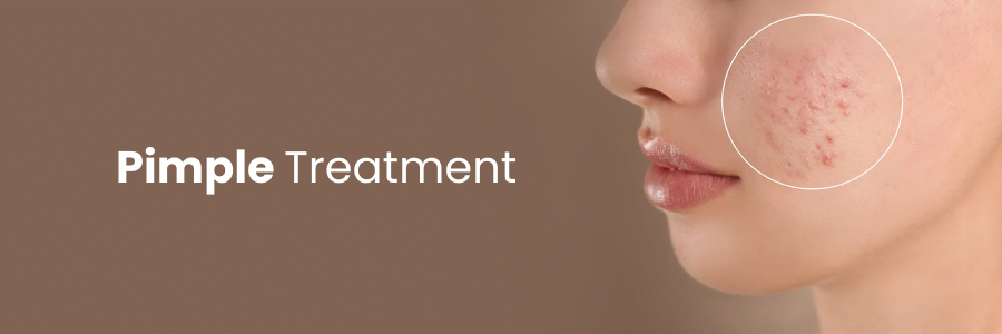 Pimple Treatment