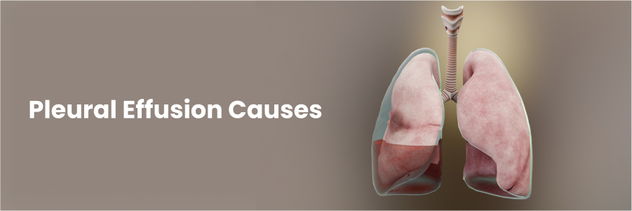 Pleural Effusion Causes