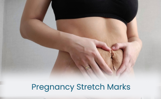 Managing Pregnancy Stretch Marks