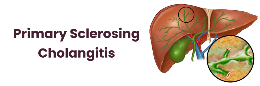 Primary Sclerosing Cholangitis