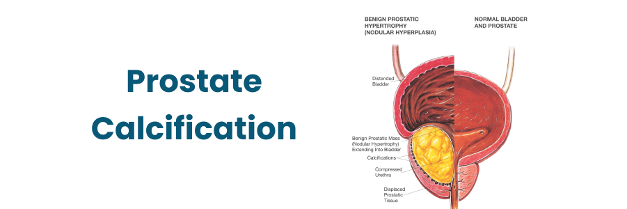 Prostate Calcification