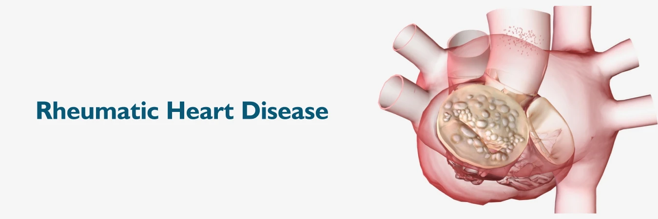 Rheumatic heart disease